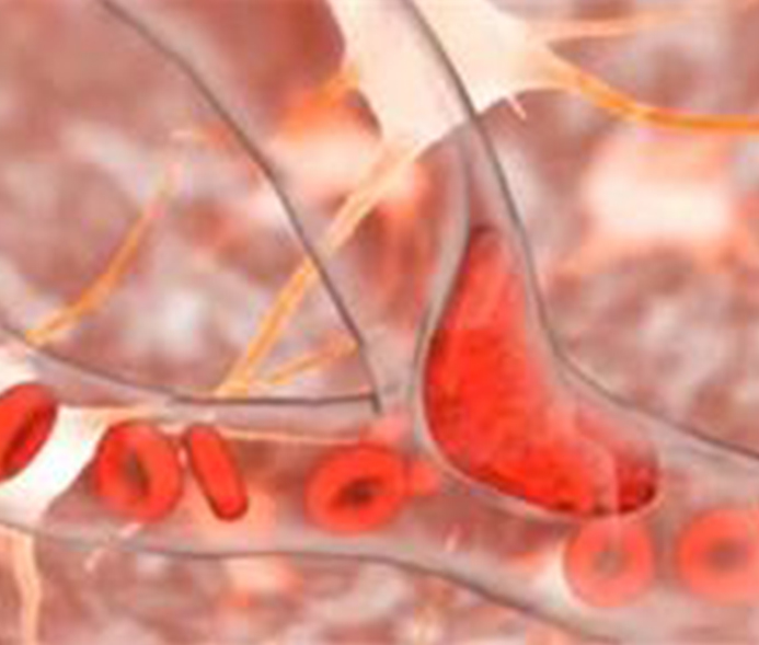 新研究揭示高原血栓病病理机制